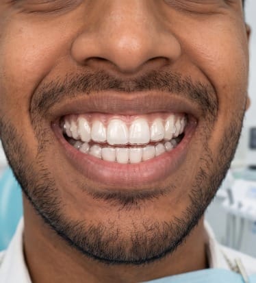 After: Aligners