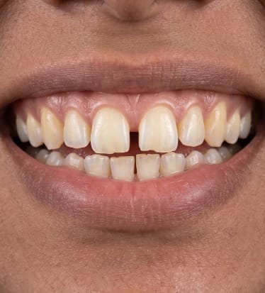 Before: Cosmetic dentistry