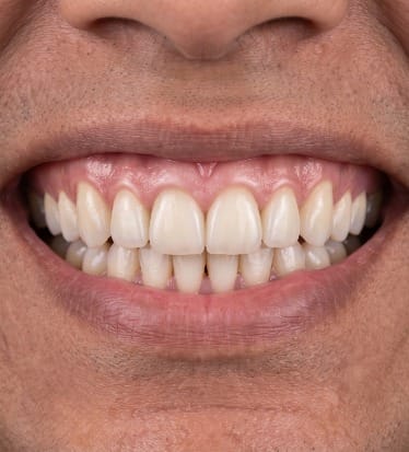 After: Dental implants
