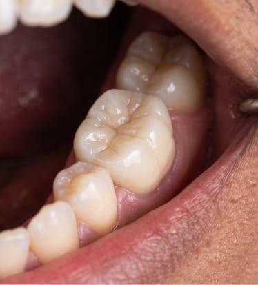 After: Root canal treatment