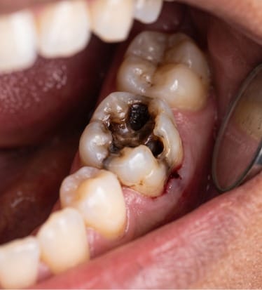 Before: Root canal treatment