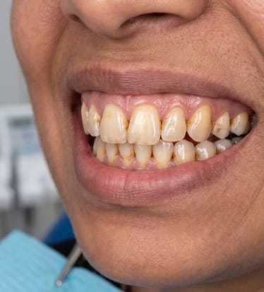 Before: Teeth whitening