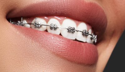 beautiful-white-teeth-braces-dental-care-photo-woman-smile-ortodontic-accessories-orthodontics-treatment-macro-shot-87506561